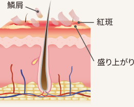 尋常性乾癬