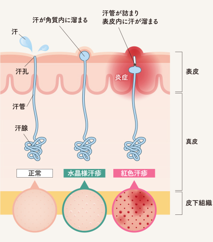 あせも（汗疹）の種類